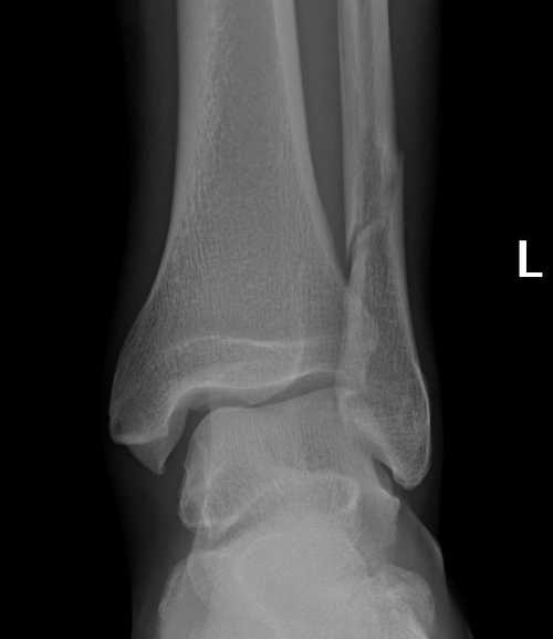 X-ray immediately after the accident