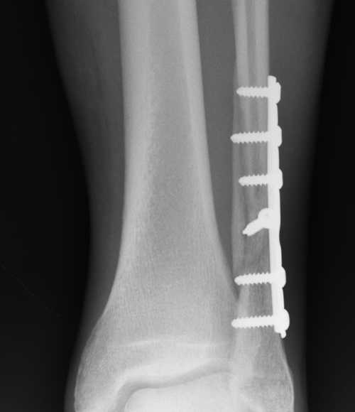 Final X-ray at week 11